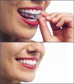 Invisalign