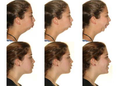 orthognathic surgery, jaw surgery,