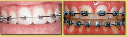 speed braces, fast orthodontics