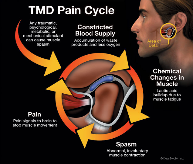 TMD, pain in jaw joint