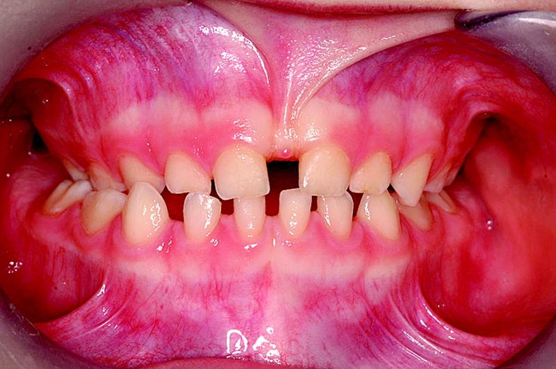 unilateral crossbite