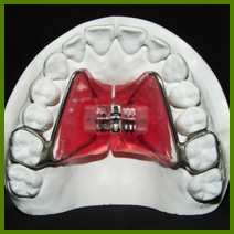 rapid palatal expander, RPE, expander